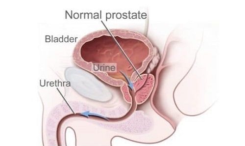 Próstata no es la única causa de STUI